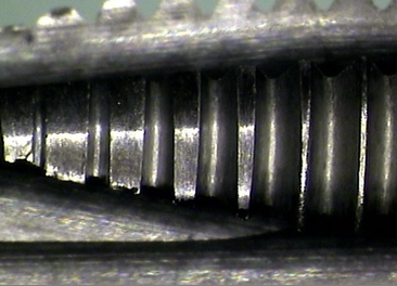 Excessive wear on the first tooth